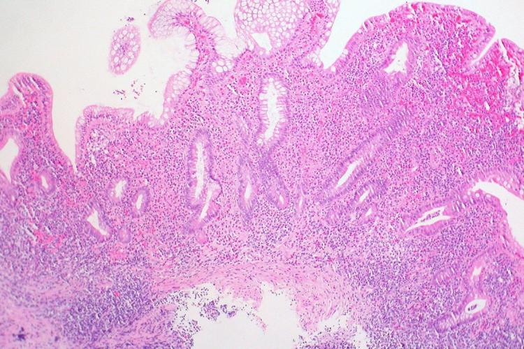 Colon biopsy showing ulcerative colitis