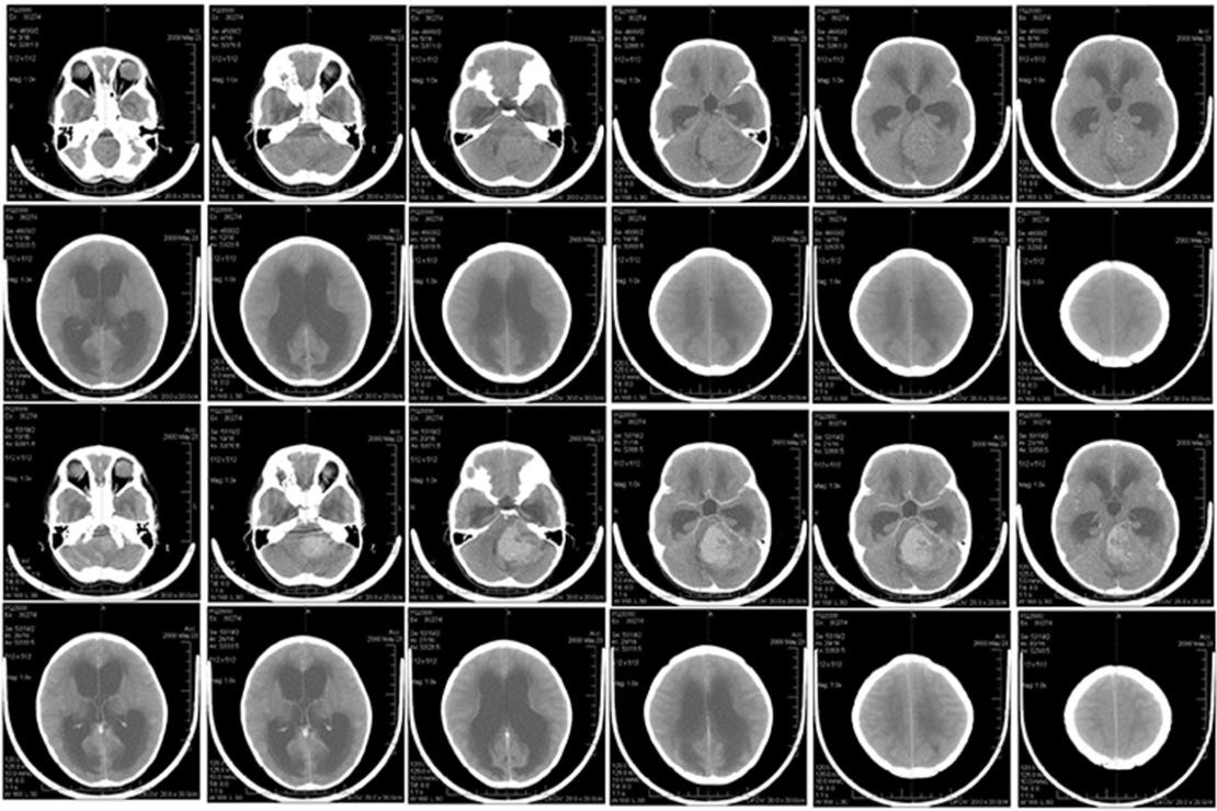 Researchers uncover molecular vulnerability in childhood brain cancer ...